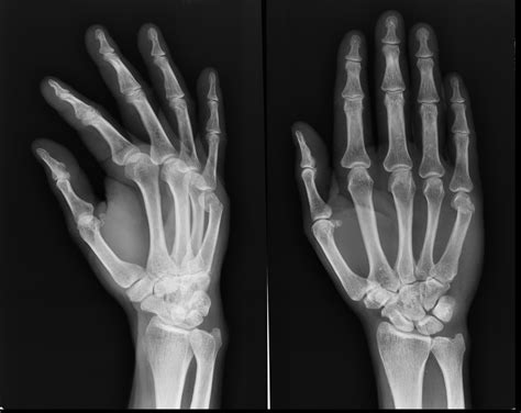 boxer's fracture metal plate|boxer's fracture on arm.